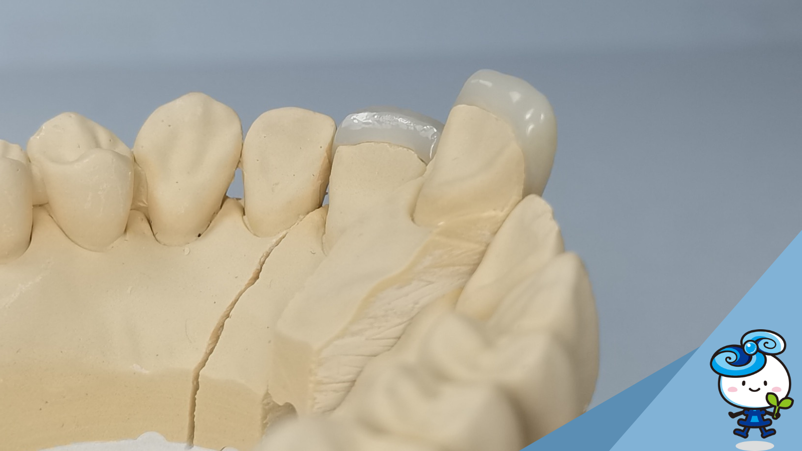 Full ZirconiaVeneer Shiken Manila Corporation