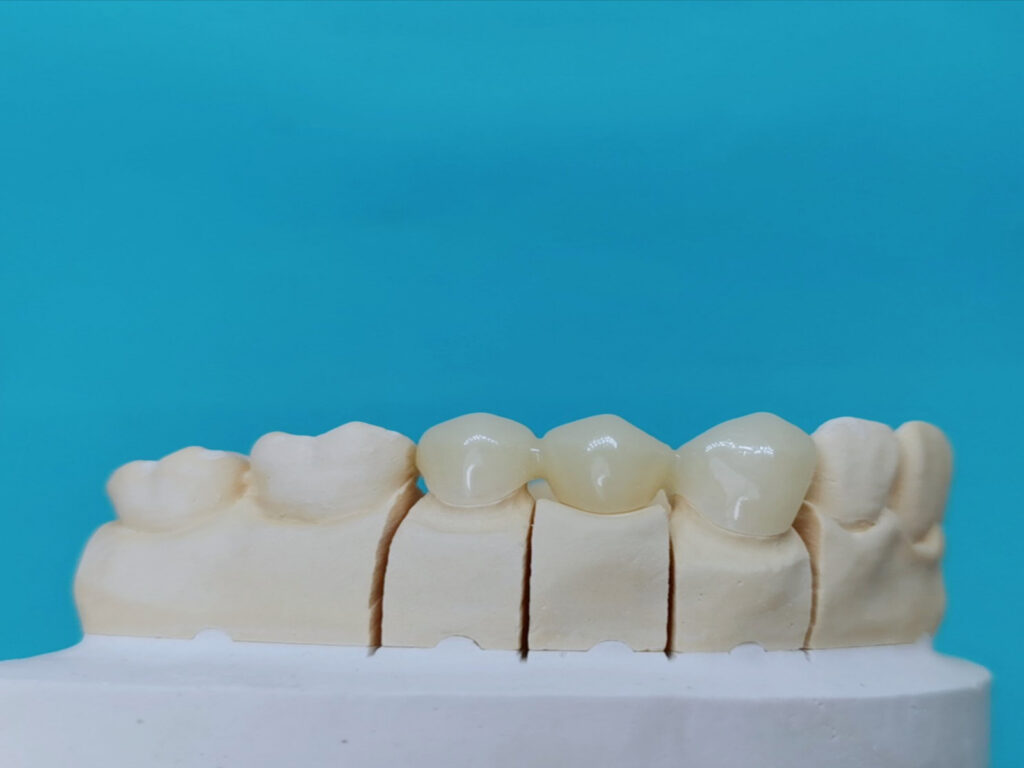 Temporary Acrylic Shiken Manila Corporation