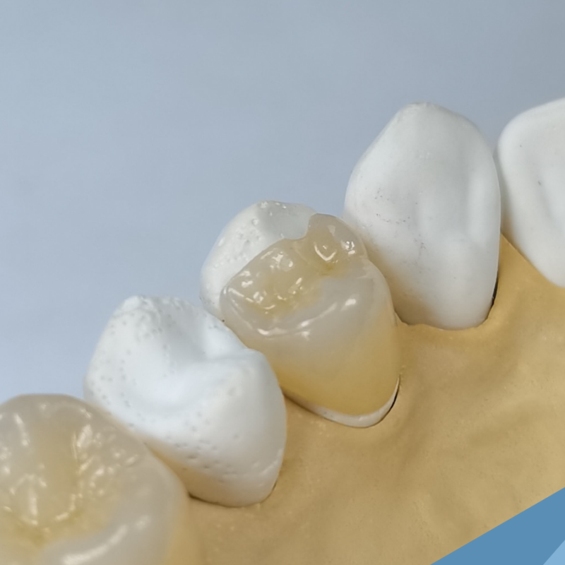 Full ZirconiaOnlay Shiken Manila Corporation