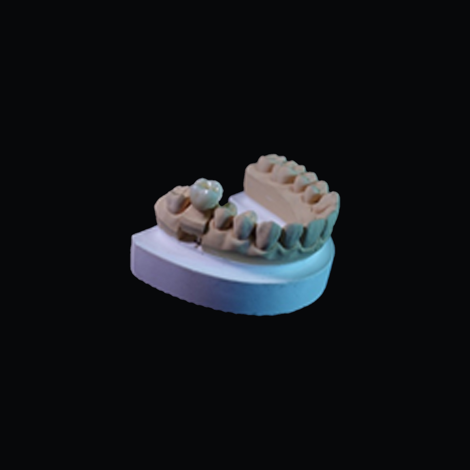 Full ZirconiaInlay Shiken Manila