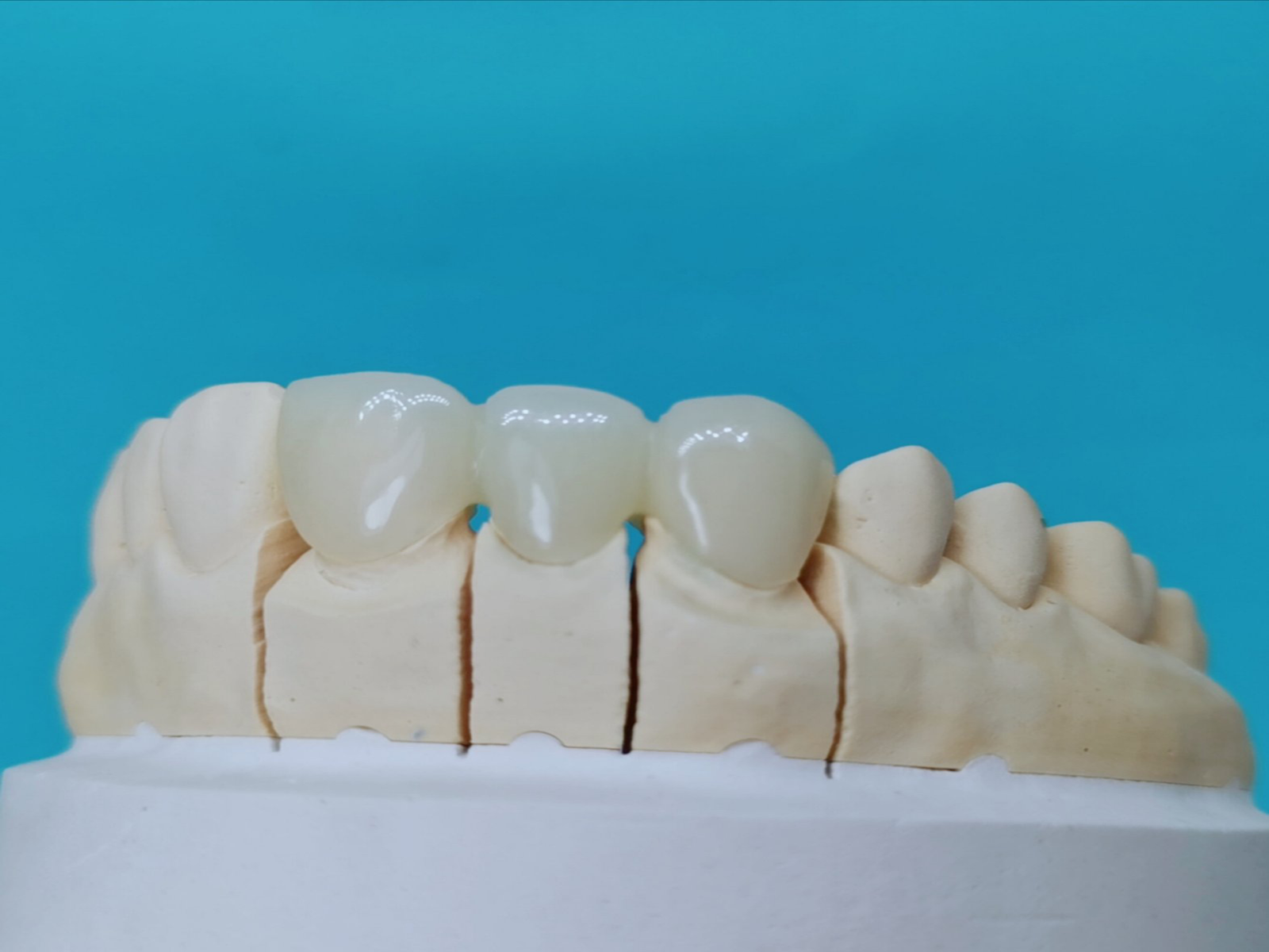 Temporary Plastic Crown Shiken Manila Corporation