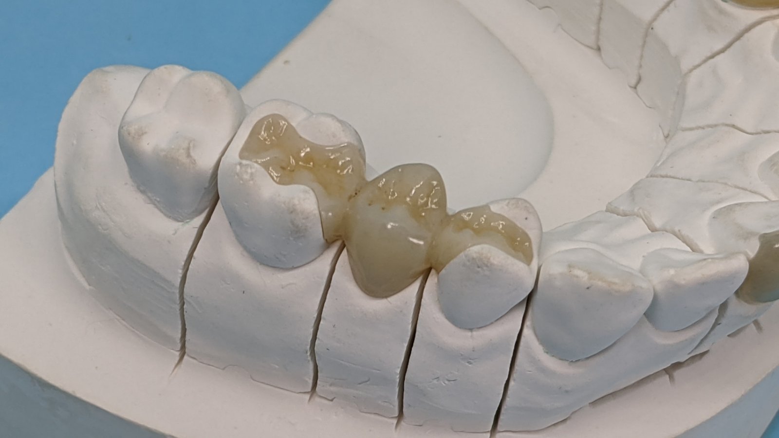 Full ZirconiaInlay Shiken Manila Corporation