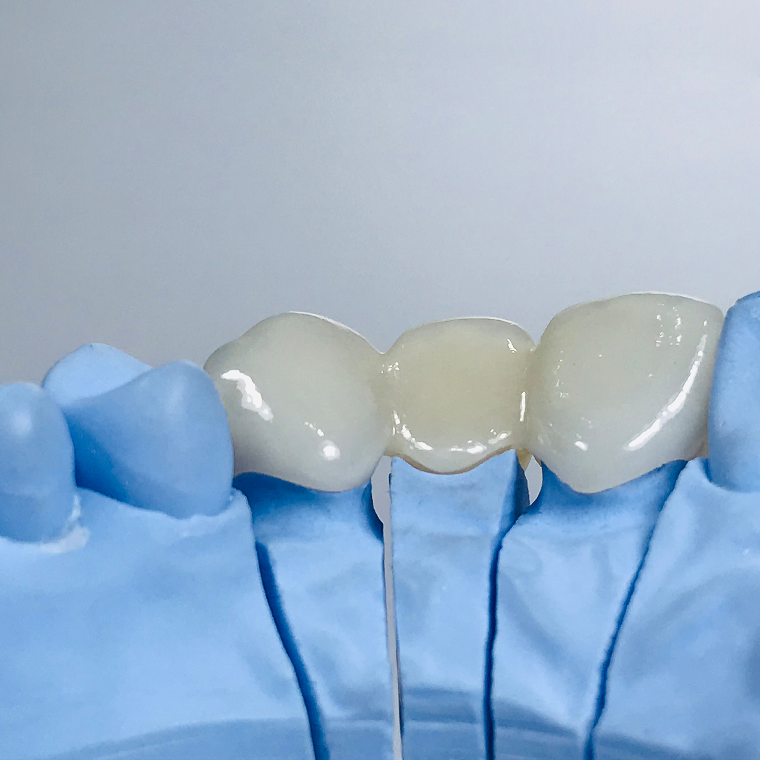 Porcelain Fused to Zirconia Shiken Manila