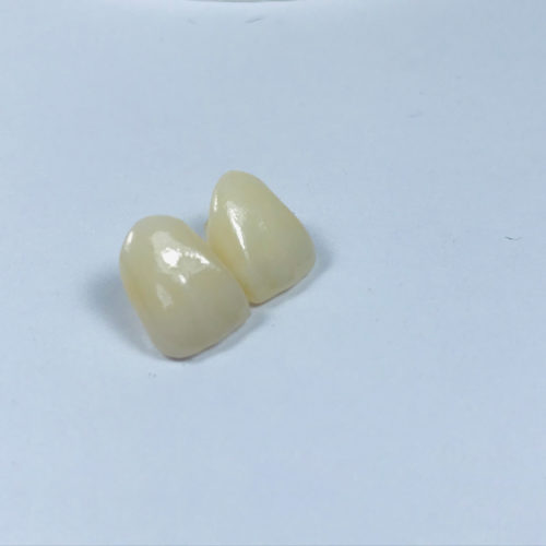 Full ZirconiaInlay Shiken Manila